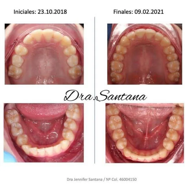 Los brackets ayudan a la mandibula